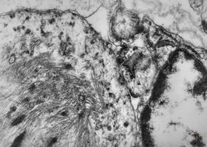 M,4m. | rhabdomyosarcoma in retented testis M,4m. | rhabdomyosarcoma in retented testis